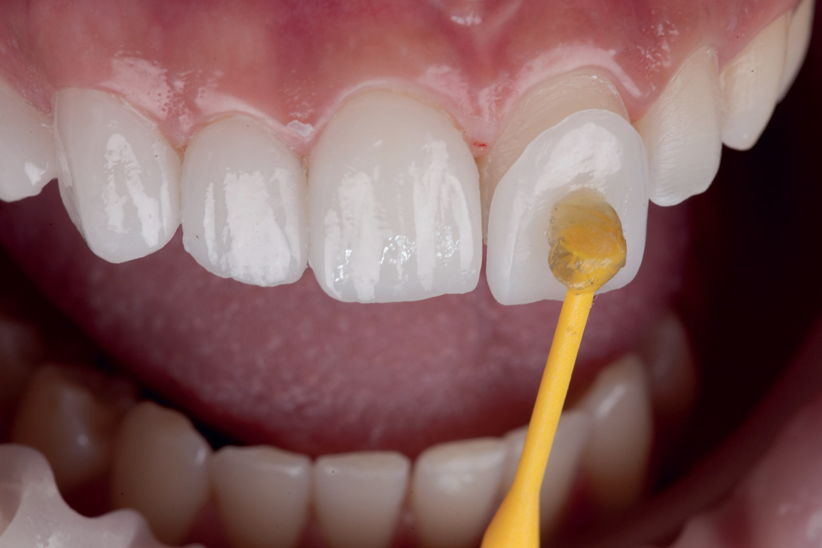 Facette dentaire en train d'être positionnée sur une dent central avec un stick jaune autocollant